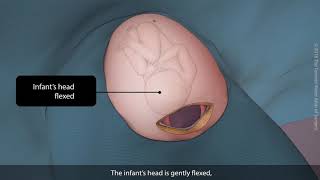 Primary vertex caesarean section Csection  TVASurg [upl. by Cornwall]