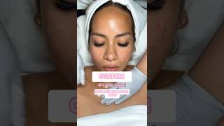 How I Treat Hormonal Acne in under 60 seconds skincareroutine acnetreatment shorts [upl. by Ransom]