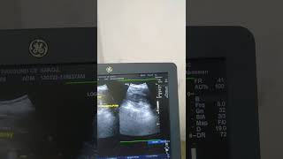 Renal Angiomyolipoma ultrasound [upl. by Linn]