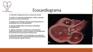 Estenosis mitral [upl. by Johnnie]