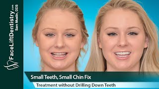 Small Teeth Chin Overbite Fix No Drill No Clear Aligners [upl. by Odawa]