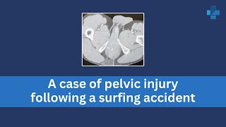 A case of pelvic injury following a surfing accident [upl. by Singleton]