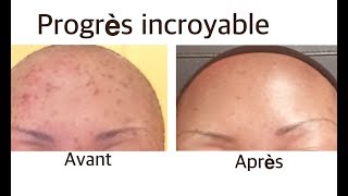 voici comment j’ai nettoyé l’acné sur mon visage  5 cadeaux 🎁  Part 2 [upl. by Ana]