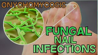 ONYCHOMYCOSIS  FUNGAL NAIL INFECTION  DEFINITION SYMPTOMS TREATMENT  EXPLAINED in 5 Minutes [upl. by Mehetabel]