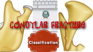 CONDYLAR FRACTURE CLASSIFICATION [upl. by Kcirdef]