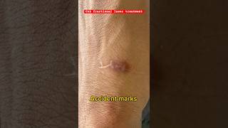 Co2 laser treatment at Akarshan Clinic laser acne scar harmcuts marks reels [upl. by Einafpets259]