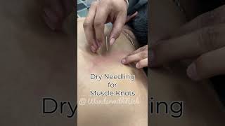 Neck pain and upper back pain treated by Chiropractic treatment and Dry needling [upl. by Fuld564]