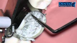 Amalgam Carving HD  Dental Perspective [upl. by Alihs]