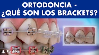 Ortodoncia – Brackets y otras partes del aparato dental © [upl. by Edda31]