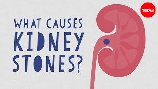 What causes kidney stones  Arash Shadman [upl. by Atilegna339]