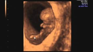 10 week 1 day ultrasound [upl. by Gearhart600]