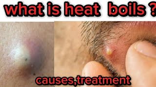 what are heat boils  By Dr Sajida Sadiq offical [upl. by Natalia]