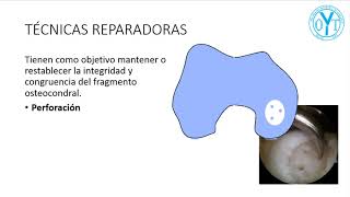 Tratamiento de Osteocondritis Disecante [upl. by Neiht593]