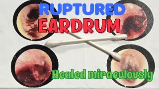 I ruptured my EARDRUM Healed in 6 months without any surgery Heres the story [upl. by Eehsar652]