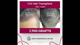 FUE Hair Transplant with 1700 grafts  2 Weeks Results [upl. by Yuzik]