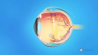 What is scleral buckle surgery [upl. by Wilek975]