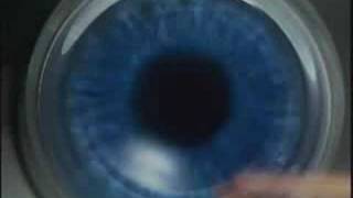 LasikPlus Intralase® Bladeless LASIK Procedure AllLaser Lasik [upl. by Oriana]