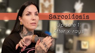 Sarcoidosis update 1 After xrays [upl. by Flossie926]