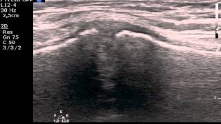 Manubriosternal joint MSKUS ultrasound [upl. by Ellekram766]