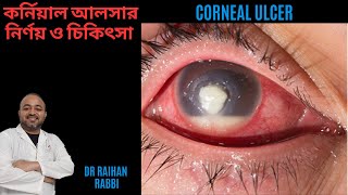 Corneal Ulcer Diagnosis amp Treatment 🔴 কর্নিয়াল আলসার নির্ণয় ও চিকিৎসা  চোখের কর্নিয়ার রোগ [upl. by Setsero]