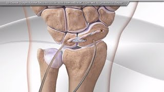 AllDorsal Scapholunate Reconstruction With InternalBrace™ Ligament Augmentation Repair [upl. by Enimisaj]