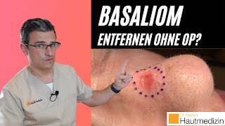 Basaliom entfernen ohne OP  Dr Kasten Hautmedizin in Mainz [upl. by Hgielrac]