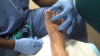 Hallux Block MWMC Podiatry [upl. by Gomar949]