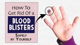 How to Get Rid of a Blood Blister Safely by Yourself [upl. by Hgielsa157]