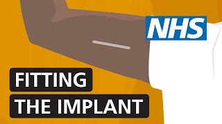 Fitting the contraceptive implant  NHS [upl. by Arika216]