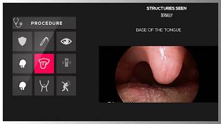 DIRECT LARYNGOSCOPY [upl. by Martelle]