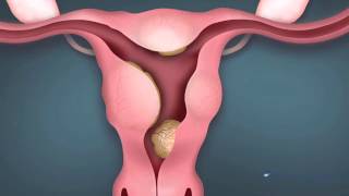 Sonohysterogram Procedure [upl. by Porcia154]