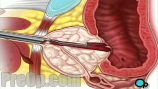 TURP Transurethral Resection Prostate penis PreOp® Patient Engagement and Education [upl. by Licastro]