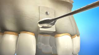 Bone Grafting Procedure Video Animation  Durham Dental Solutions [upl. by Jordison]