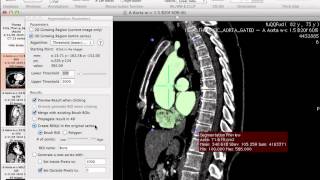 Generating 3D models using Osirix [upl. by Binah]