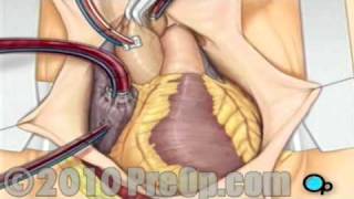 Coronary Artery Bypass CABG Surgery [upl. by Sille]