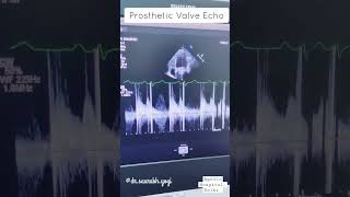 Mitral valve prosthesis 2D Echo  2D Echo  Rare Case Finding [upl. by Millda349]