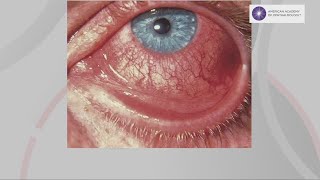 Is a new COVID variant causing more cases of pink eye [upl. by Eiramanel767]