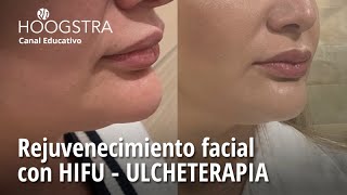 Rejuvenecimiento facial con HIFU  ULCHETERAPIA  24105 [upl. by Conlen166]