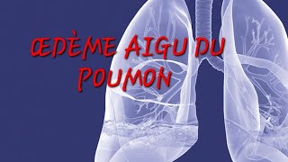 ŒDÈME AIGU DU POUMON [upl. by Os]