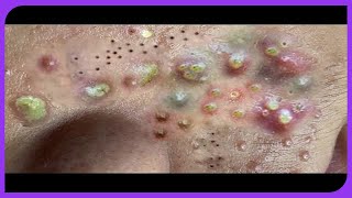 Satisfying Blackheads Removal Popping Pimples and Blackheads on Skin 2024 [upl. by France466]