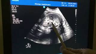 Posterior Urethral Valve PUV Sonography [upl. by Nyrem]