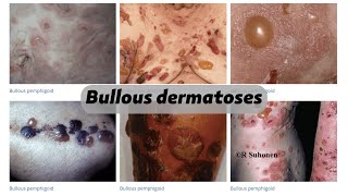 Bullous dermatoses [upl. by Nyleda]