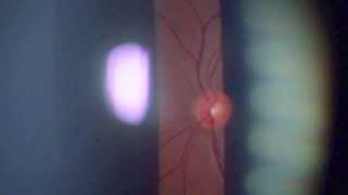 RETINAL FUNDUS 78D LENS BIOMICROSCOPY [upl. by Oletha]