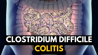 CLOSTRIDIUM DIFFICILE COLITIS Causes Signs and Symptoms Diagnosis and Treatment [upl. by Llyrpa]