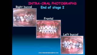 beggs technique part  orthodontic courses by Indian dental academy [upl. by Euqinotna479]