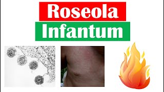 Roseola Infantum Sixth Disease  Symptoms Fever amp Rash in Infants Diagnosis Treatment [upl. by Anirhtak338]