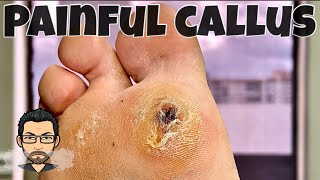 CALLUS REMOVAL FROM FEET [upl. by Dylana]