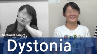 Cervical Dystonia Dystonia Spasmodic Torticollis  사경증 치료사례  근긴장이상증 [upl. by Riane21]