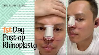 Rhinoplasty In the Philippines 1st Day Post Opp [upl. by Anneuq347]