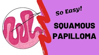 Squamous Papilloma  Oral Pathology Lectures [upl. by Penthea216]